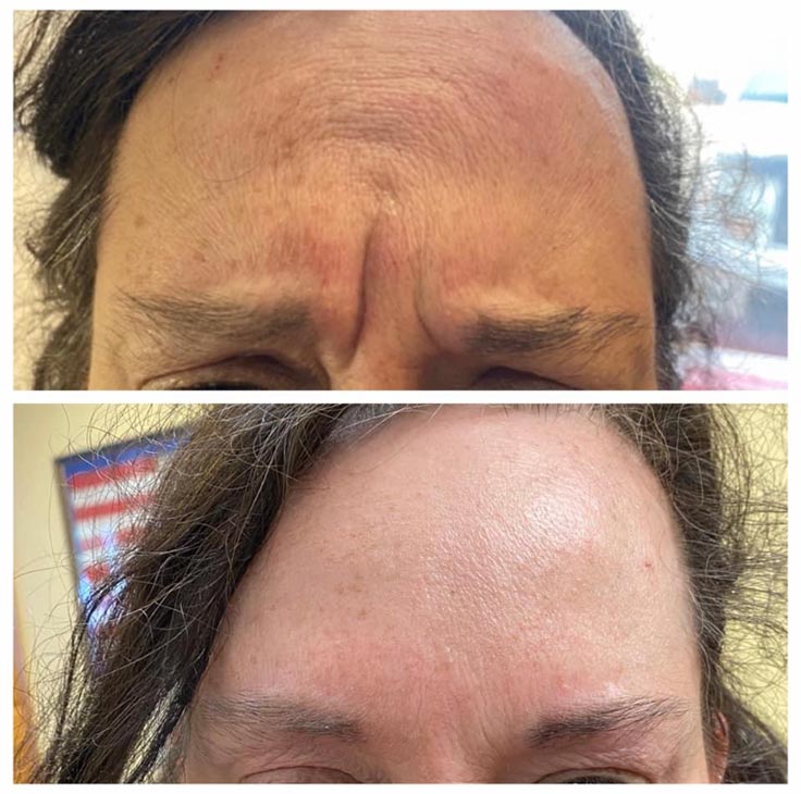 Chiropractic Superior WI Botox Before And After