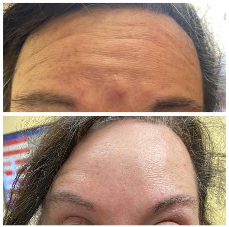 Chiropractic Superior WI Botox Before And After