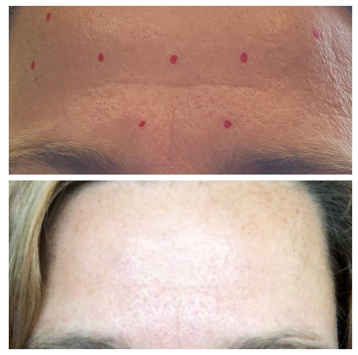 Chiropractic Superior WI Botox Before And After