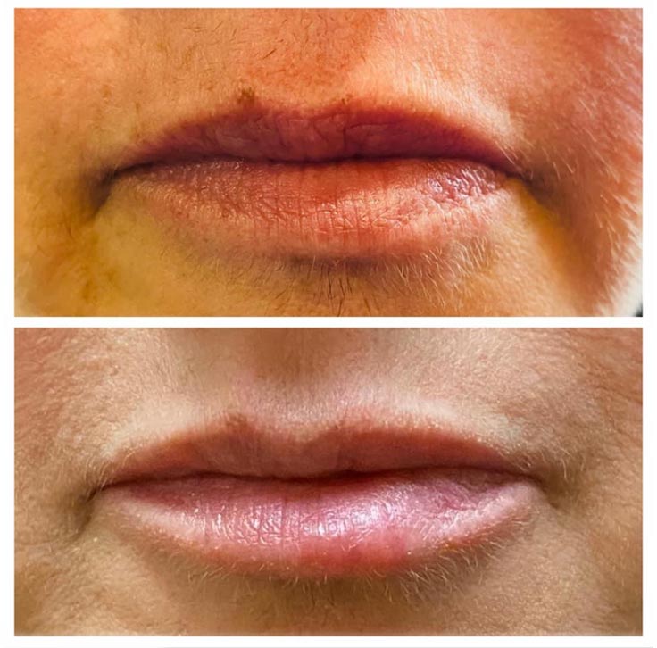 Chiropractic Superior WI Lip Injection Before And After