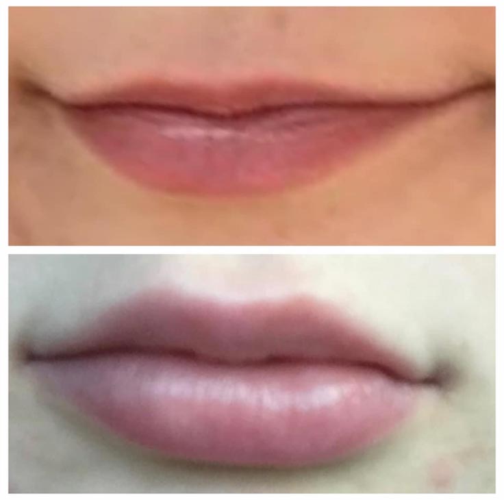 Chiropractic Superior WI Lip Injection Before And After
