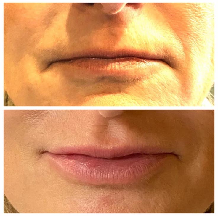 Chiropractic Superior WI Lip Injection Before And After