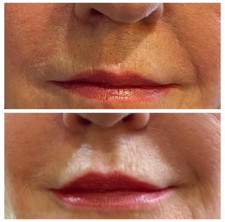 Chiropractic Superior WI Lip Injection Before And After Chiropractic Superior WI Lip Injection Before And After
